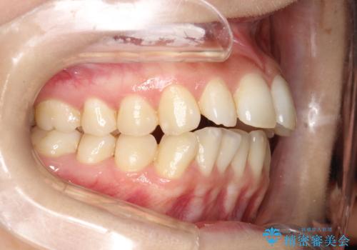出っ歯で口が閉じずらい　ワイヤーによる抜歯矯正の症例 治療前