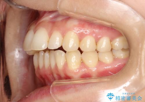 出っ歯で口が閉じずらい ワイヤーによる抜歯矯正の治療前