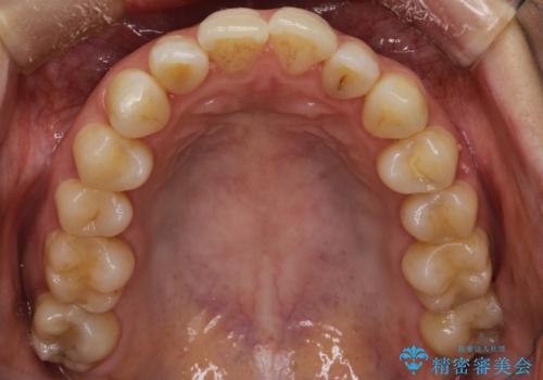 出っ歯で口が閉じずらい ワイヤーによる抜歯矯正の治療前