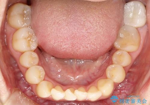 出っ歯で口が閉じずらい ワイヤーによる抜歯矯正の治療前