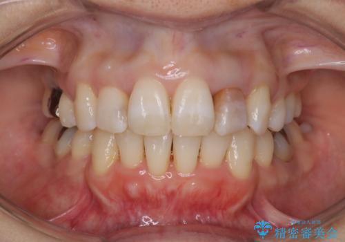 重度のガタガタと出っ歯をワイヤーによる抜歯矯正で整った歯並びへの症例 治療後