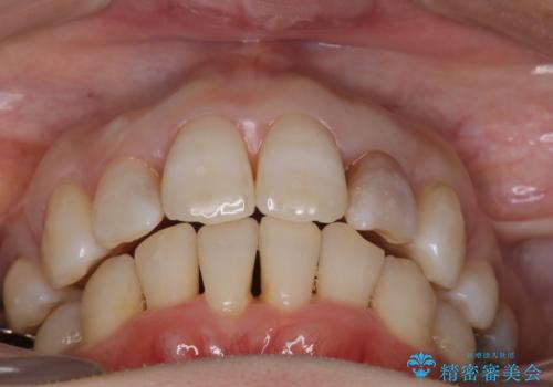 重度のガタガタと出っ歯をワイヤーによる抜歯矯正で整った歯並びへの治療後