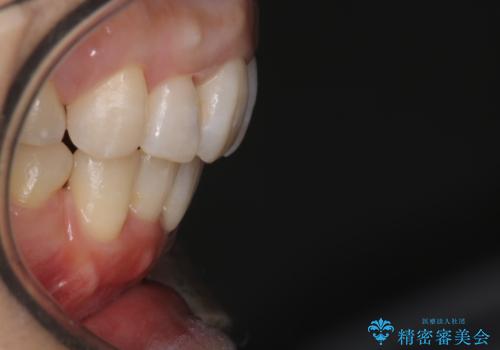 重度のガタガタと出っ歯をワイヤーによる抜歯矯正で整った歯並びへの治療後