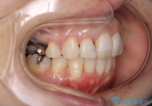 重度のガタガタと出っ歯をワイヤーによる抜歯矯正で整った歯並びへの治療後