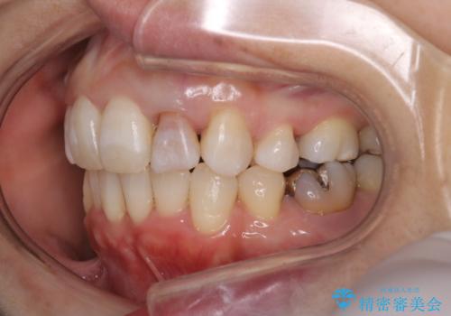 重度のガタガタと出っ歯をワイヤーによる抜歯矯正で整った歯並びへの治療後