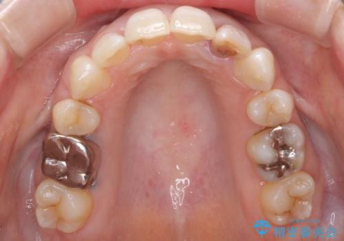 重度のガタガタと出っ歯をワイヤーによる抜歯矯正で整った歯並びへの治療後