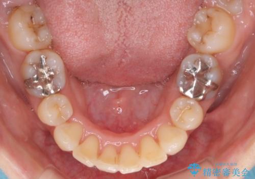 重度のガタガタと出っ歯をワイヤーによる抜歯矯正で整った歯並びへの治療後