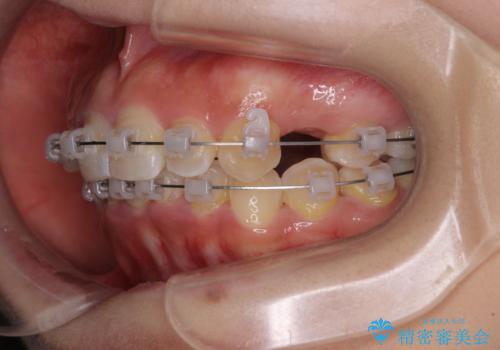 【モニター】八重歯とデコボコをスッキリきれいに　ワイヤー装置での抜歯矯正の治療中