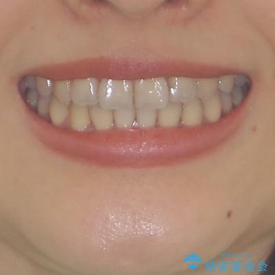 前歯のクロスバイト ワイヤー装置を併用したインビザライン矯正の治療後(顔貌)