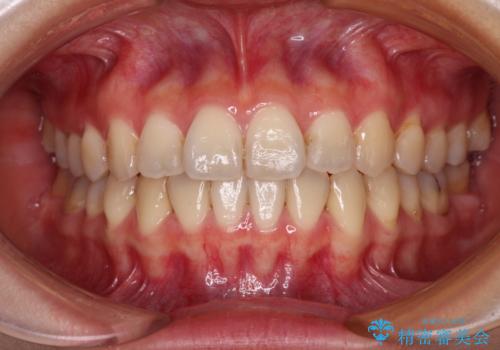 前歯のクロスバイト ワイヤー装置を併用したインビザライン矯正の症例 治療後