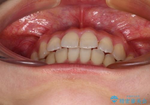 前歯のクロスバイト ワイヤー装置を併用したインビザライン矯正の治療後