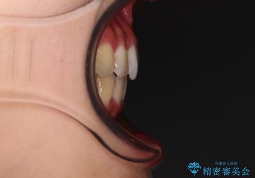前歯のクロスバイト　ワイヤー装置を併用したインビザライン矯正の治療後