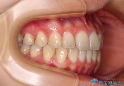 前歯のクロスバイト ワイヤー装置を併用したインビザライン矯正の治療後