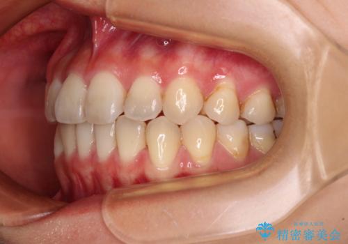 前歯のクロスバイト ワイヤー装置を併用したインビザライン矯正の治療後