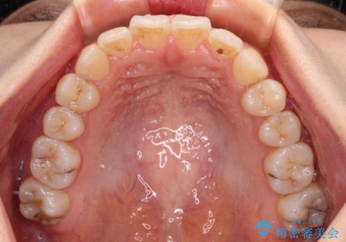 前歯のクロスバイト ワイヤー装置を併用したインビザライン矯正の治療後