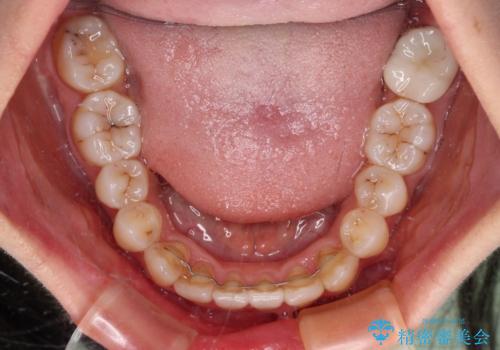 前歯のクロスバイト ワイヤー装置を併用したインビザライン矯正の治療後