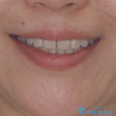 極端な上下前歯の開咬を改善　オープンバイトのインビザライン矯正の治療後（顔貌）