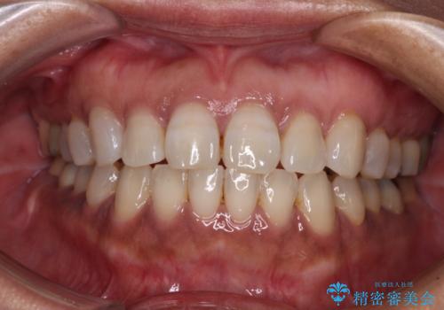 極端な上下前歯の開咬を改善　オープンバイトのインビザライン矯正の症例 治療後