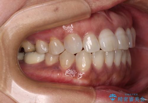極端な上下前歯の開咬を改善　オープンバイトのインビザライン矯正の治療後
