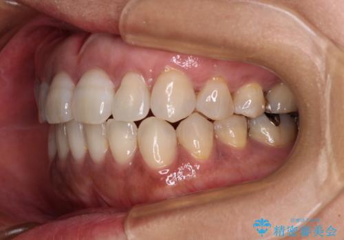 極端な上下前歯の開咬を改善　オープンバイトのインビザライン矯正の治療後