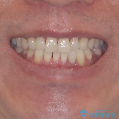 内側にある歯が干渉する　上顎前歯の部分矯正の治療前（顔貌）