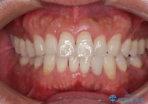 内側にある歯が干渉する　上顎前歯の部分矯正の治療前