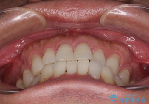 内側にある歯が干渉する 上顎前歯の部分矯正の治療前