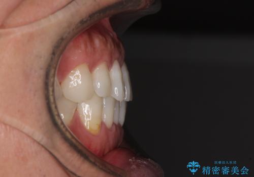 内側にある歯が干渉する 上顎前歯の部分矯正の治療前