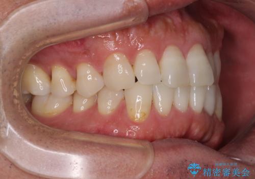 内側にある歯が干渉する 上顎前歯の部分矯正の治療前