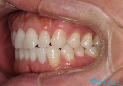 内側にある歯が干渉する 上顎前歯の部分矯正の治療前