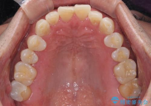 内側にある歯が干渉する 上顎前歯の部分矯正の治療前