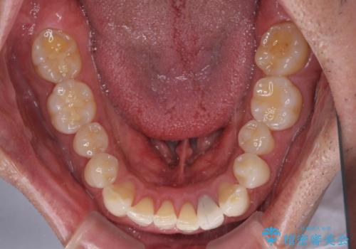 内側にある歯が干渉する 上顎前歯の部分矯正の治療前