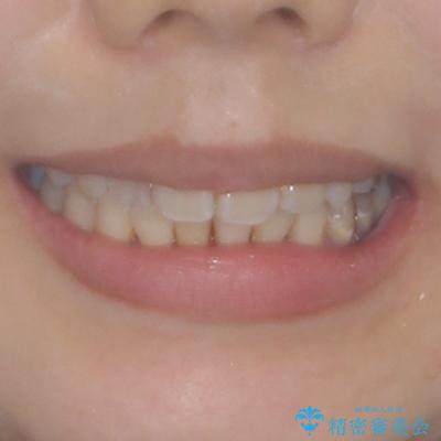 デコボコで磨きにくい前歯をスッキリと　インビザライン矯正の治療後（顔貌）