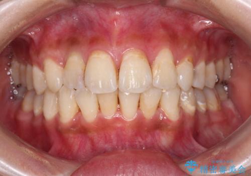 デコボコで磨きにくい前歯をスッキリと インビザライン矯正の治療中