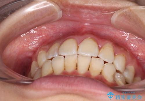 デコボコで磨きにくい前歯をスッキリと インビザライン矯正の治療中