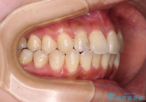 デコボコで磨きにくい前歯をスッキリと　インビザライン矯正の治療中