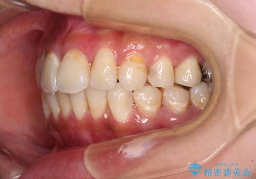 デコボコで磨きにくい前歯をスッキリと インビザライン矯正の治療中