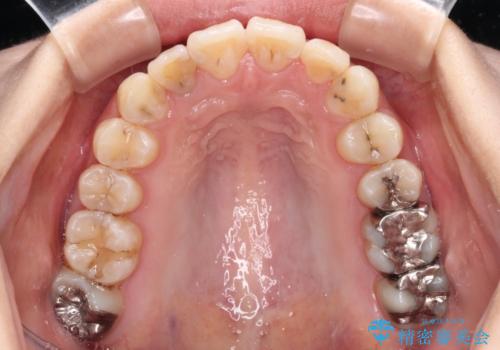 デコボコで磨きにくい前歯をスッキリと インビザライン矯正の治療中