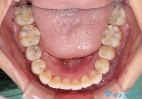 デコボコで磨きにくい前歯をスッキリと インビザライン矯正の治療中