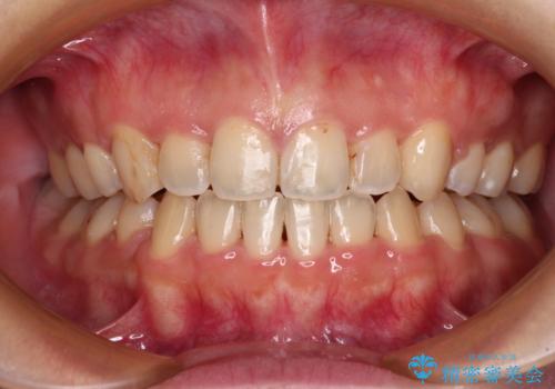 八重歯を抜歯矯正でスッキリと メタルブラケットでの矯正治療の症例 治療後