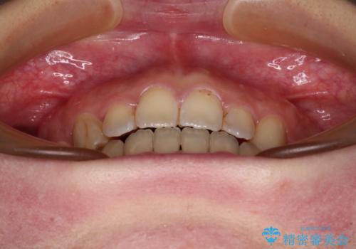 八重歯を抜歯矯正でスッキリと メタルブラケットでの矯正治療の治療後