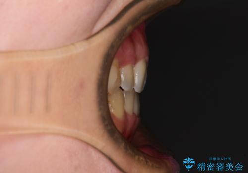 八重歯を抜歯矯正でスッキリと メタルブラケットでの矯正治療の治療後