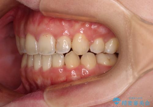 八重歯を抜歯矯正でスッキリと メタルブラケットでの矯正治療の治療後