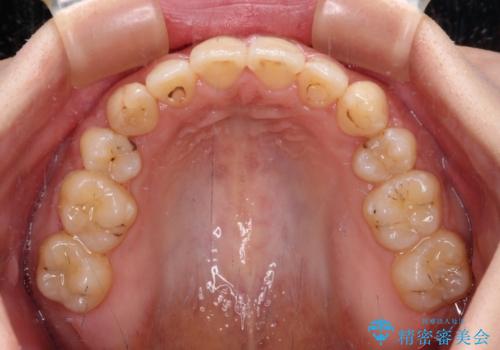 八重歯を抜歯矯正でスッキリと　メタルブラケットでの矯正治療の治療後