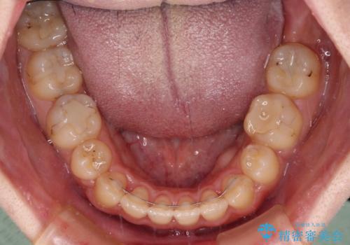 八重歯を抜歯矯正でスッキリと メタルブラケットでの矯正治療の治療後