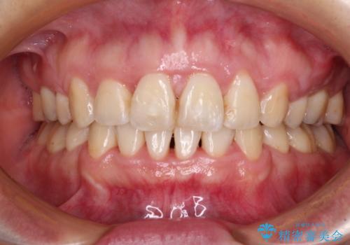 出っ歯による口の閉じにくさを治したい　ワイヤー装置を用いた抜歯矯正の治療後