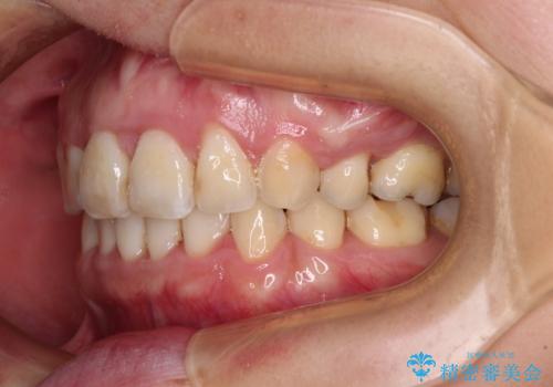 出っ歯による口の閉じにくさを治したい　ワイヤー装置を用いた抜歯矯正の治療後