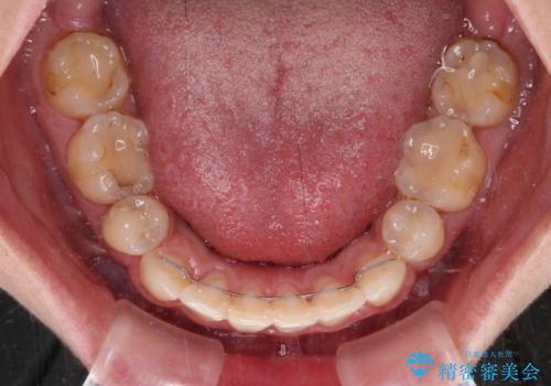 出っ歯による口の閉じにくさを治したい ワイヤー装置を用いた抜歯矯正の治療後