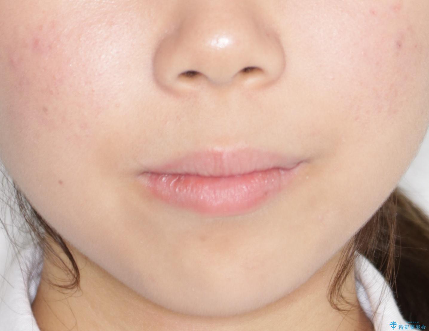 【前歯の見た目をキレイにしたい、引っ込んだ歯も気になる】インビザライン症例の治療前(顔貌)