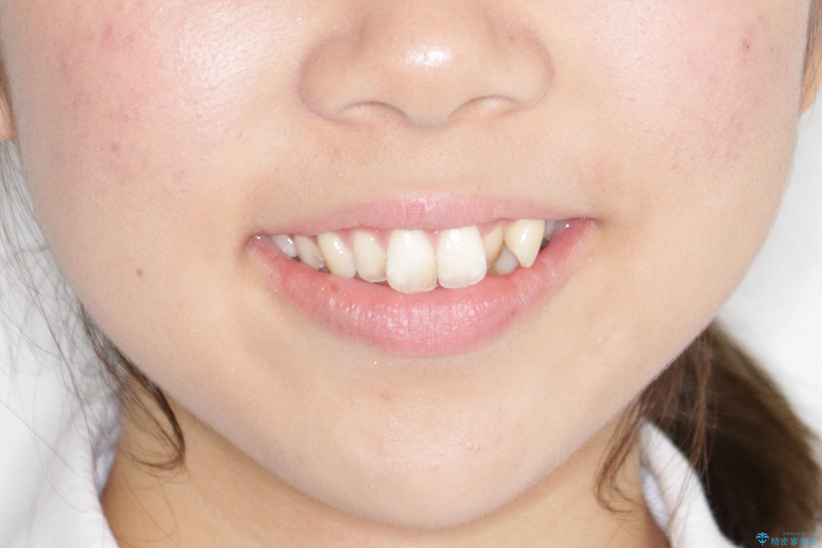 【前歯の見た目をキレイにしたい、引っ込んだ歯も気になる】インビザライン症例の治療前(顔貌)